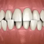 Crowded Teeth