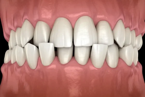 Crowded Teeth